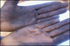 Hands of Mr. John Malanda - a cotton grower in Petauke (Eastern province of Zambia)